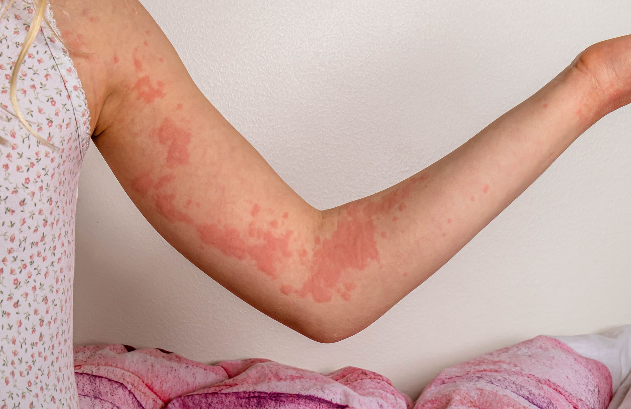 Hidden Allergy Symptoms: Beyond the Itch